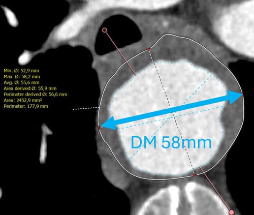 Endovascular therapy of the thoracic aorta: Kinked Anatomy (proximal descending!)
