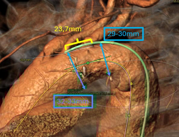 Endovascular therapy of the thoracic aorta: Distal Arch / Proximal Descending