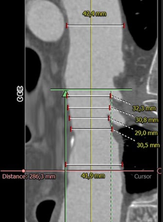 Endovascular therapy of the thoracic aorta: Distal Arch / Proximal Descending