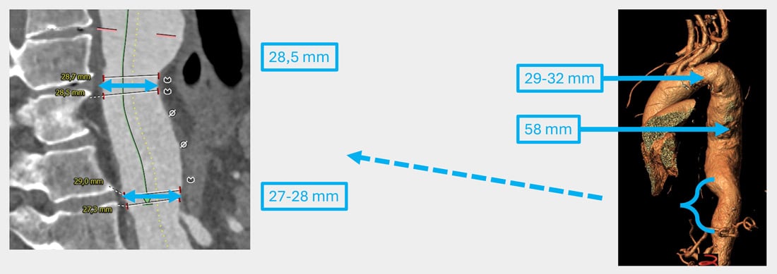 Endovascular therapy of the thoracic aorta: Distal Landing zone