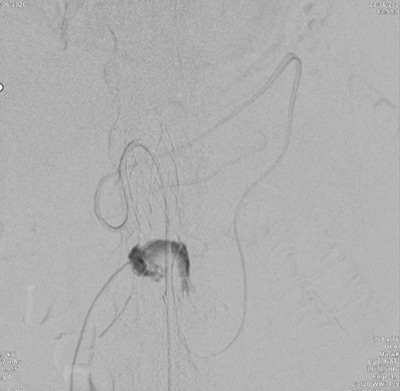 Recurrent endoleak type II