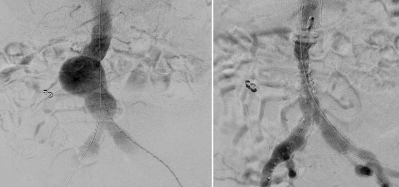 Recurrent endoleak type II: EVAR for 52mm infrarenal AAA with Ovation ALTO with right renal polar embolization.