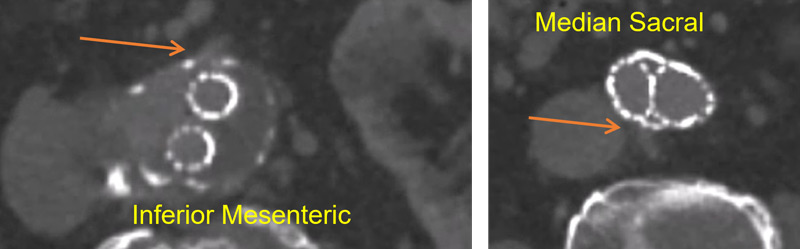 Recurrent endoleak type II: Follow-up with EL2 and sac growth (57mm). 
