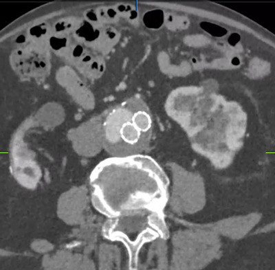 Recurrent endoleak type II: Trancaval embolization (TCE)