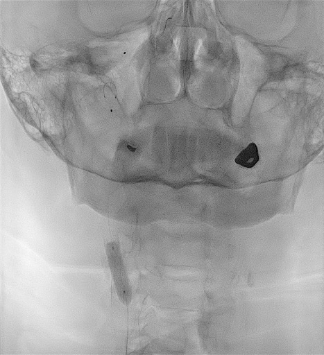 Severe CAS associated with contralateral carotid occlusion: Type 1 aortic arch