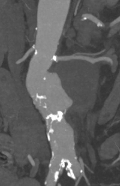 2cm sac expansion of sacciform juxtarenal aneurysm up to 75mm