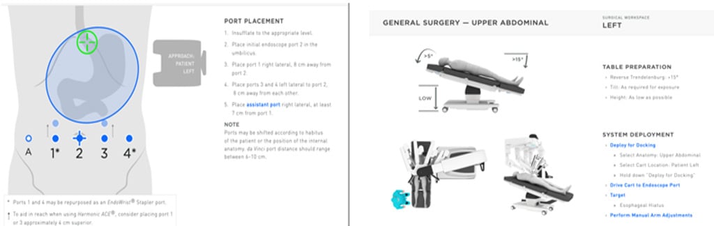 After pneumoperitoneum induction, the flaccid part was opened and splenic