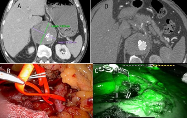 Robotic celiac trunk ligature