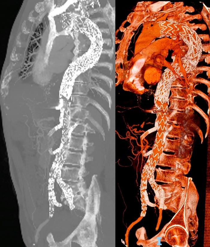 Complete type II endoleak resolution