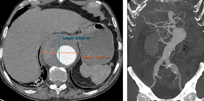 Urgent CT scan: voluminous thoraco-abdominal  aneurysm and bilateral iliac aneurysm