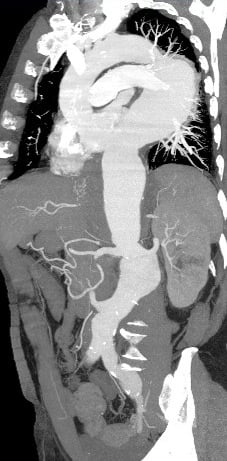 Urgent CT scan: voluminous thoraco-abdominal  aneurysm and bilateral iliac aneurysm