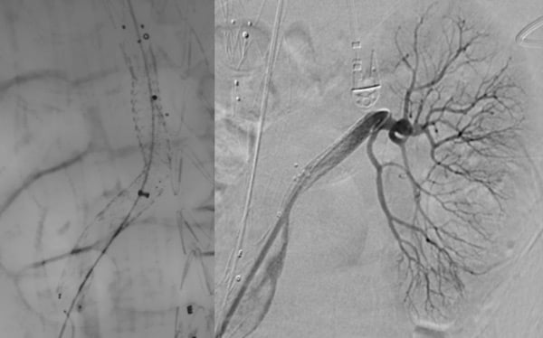 STEP 2:  SMA and LRA stenting