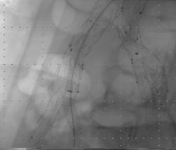 STEP 3:  Bilateral Iliac Branch