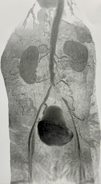 MRI: Severe atheromatosis