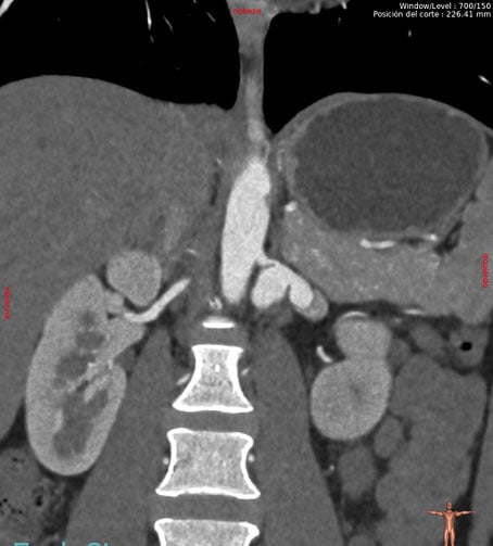 coronal slices