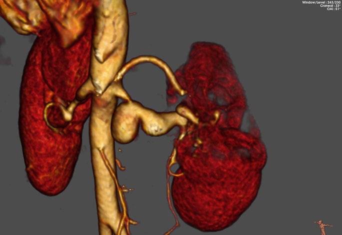 Coronal 3D reconstruction 