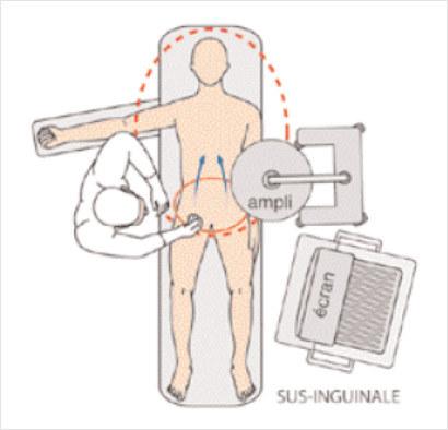 Retrograde femoral puncture