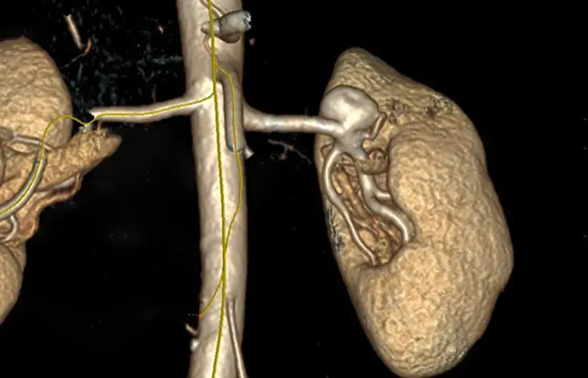 How to manage distal renal artery aneurysm