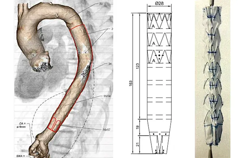  Branched stent-graft used for type IV thoracoabdominal aortic aneurysm repair of a patient with abdominal aortic agenesis