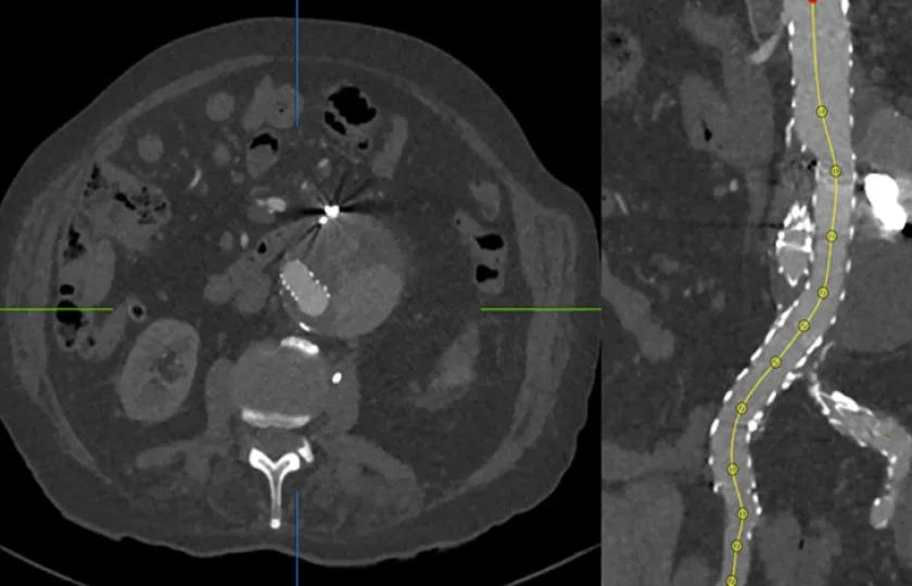 Re-do endovascular endoleak embolisation by transprosthetic puncture after endovascular aneurysm repair