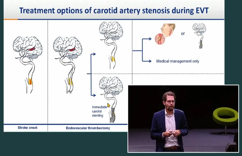 Carotid updates and controversies