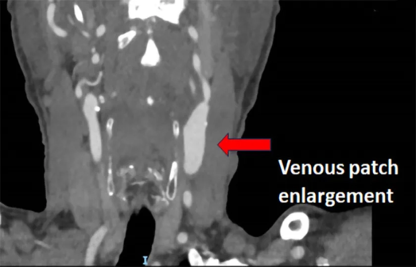 Unusual carotid enlargement after CEA