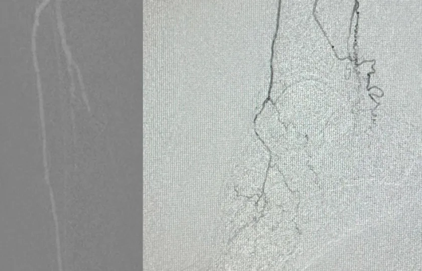 Treatment for no-option CLTI patient