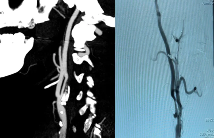 Asymptomatic carotid stenosis stenting