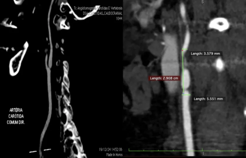 Carotid stenosis: the athero-mystery