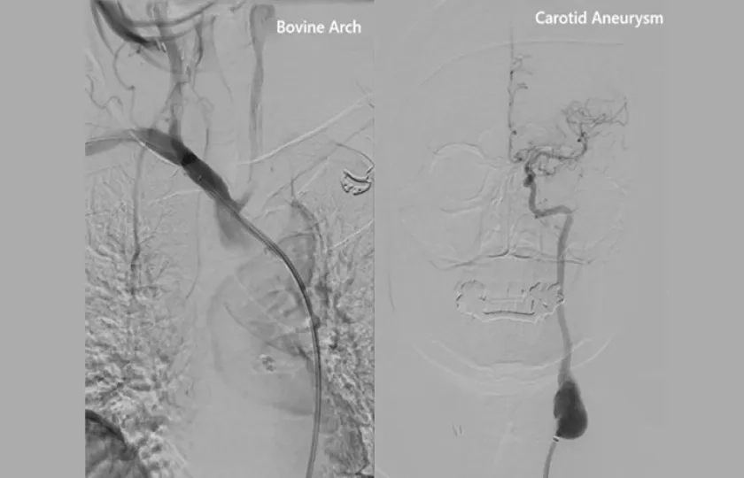 Endovascular Management of a Carotid Aneurysm in a Patient with Prior Carotid Surgery and Bovine Aortic Arch