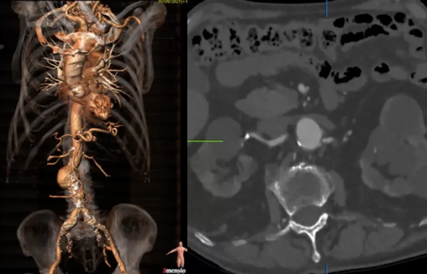 Treatment of recurrent endoleak type II