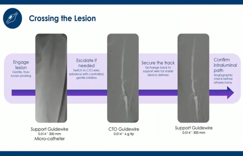 Modern endovascular decisions for SFA intervention 