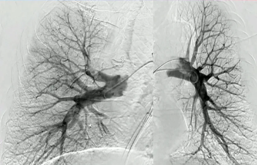 Pulmonary embolism: breaking the clot barrier