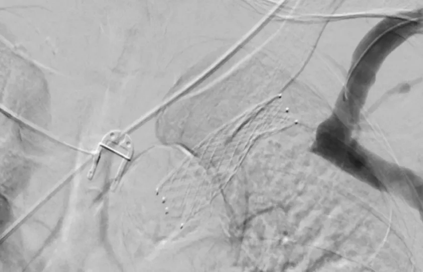 When complex intra-stent occlusion demands outside-the-box thinking