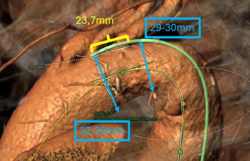 Patient-tailored endovascular therapy of the thoracic aorta