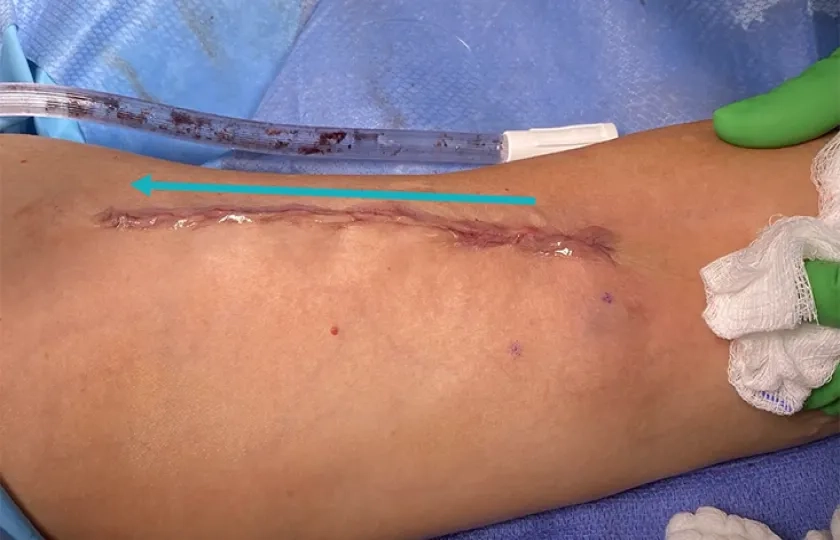 From planning to patency: optimizing AV access maturation, cannulation and intervention