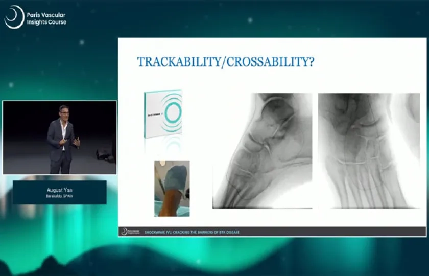 Shockwave IVL: cracking the barriers of below-the-knee disease