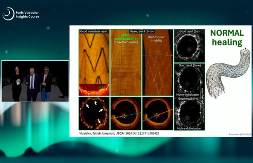 The role of MicroNet covered carotid stents in the post- CREST-2 world