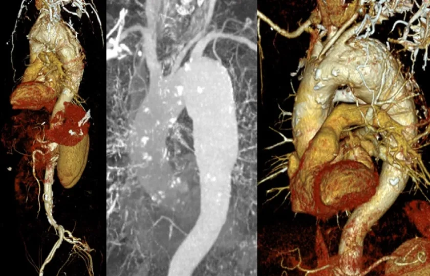 Tailored approach of an anatomically challenging aortic arch aneurysm: when one size does not fit