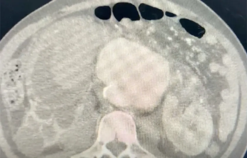 Endovascular treatment for rescue hematuria with shock patient