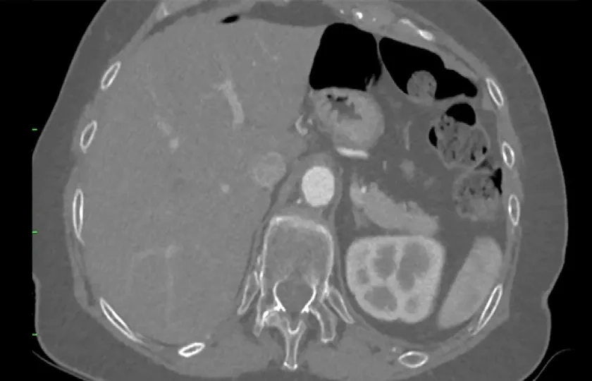 Aorto-iliac treatment