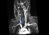 A real-life carotid artery stenosis case