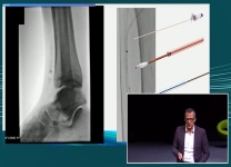 Simplifying complex BTK interventions with Oscar