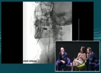 Dedicated carotid stent with optimal embolic protection - Best in class!