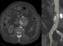 Re-do endovascular endoleak embolisation by transprosthetic puncture after endovascular aneurysm repair