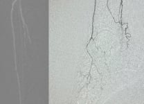 Treatment for no-option CLTI patient