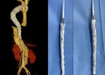 Total endo‑aortic repair for a triple‑lumen post‑dissection TAAA