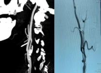Asymptomatic carotid stenosis stenting