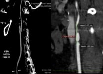 Carotid stenosis: the athero-mystery
