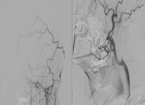 TIA in bilateral severe carotid disease